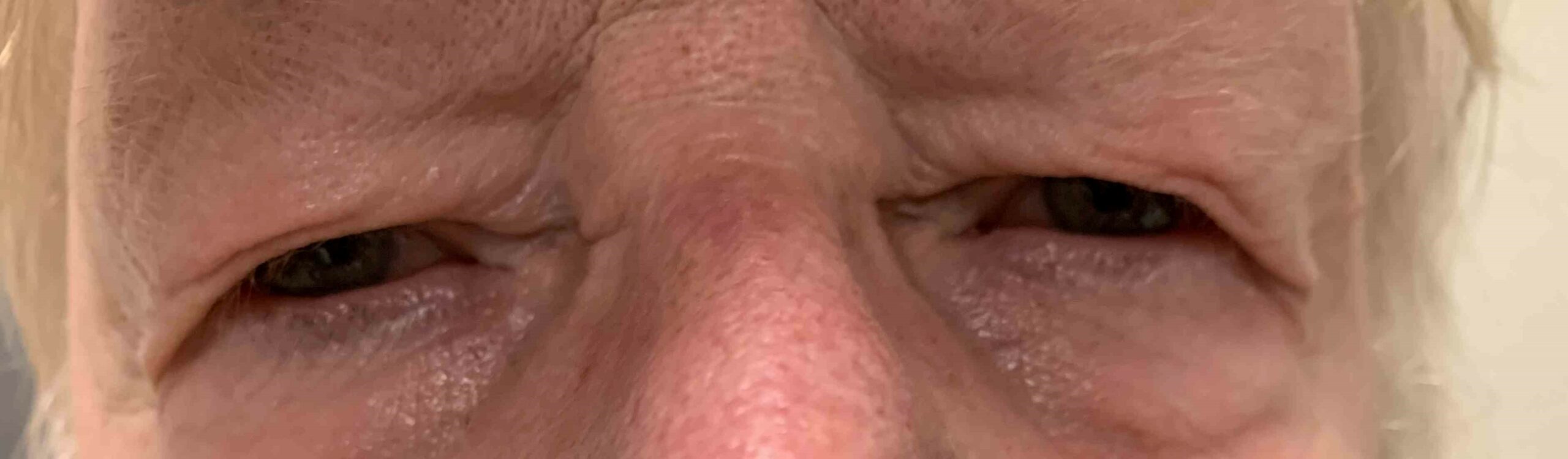 Blepharoplastie