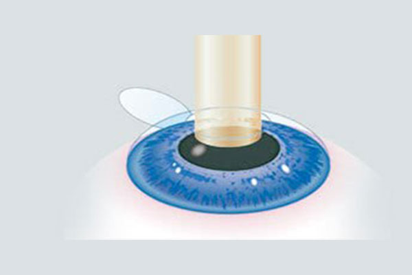 lasik1