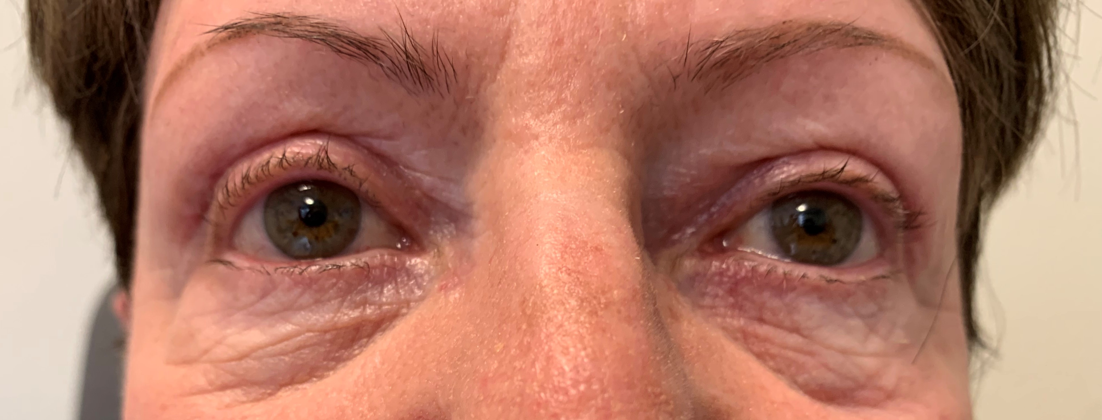 Belpharoplastie inf apres