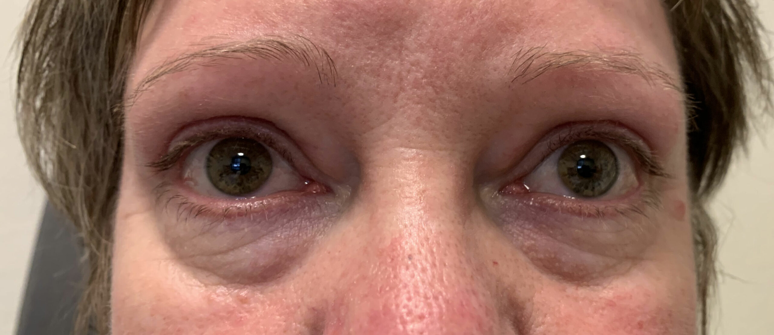 Belpharoplastie-sup-2-after