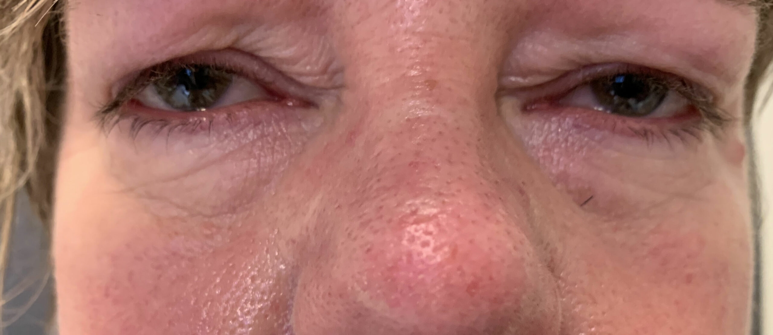 Belpharoplastie-sup-avant